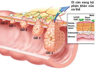 Ung thư đang là đại dịch ở Việt Nam - 0