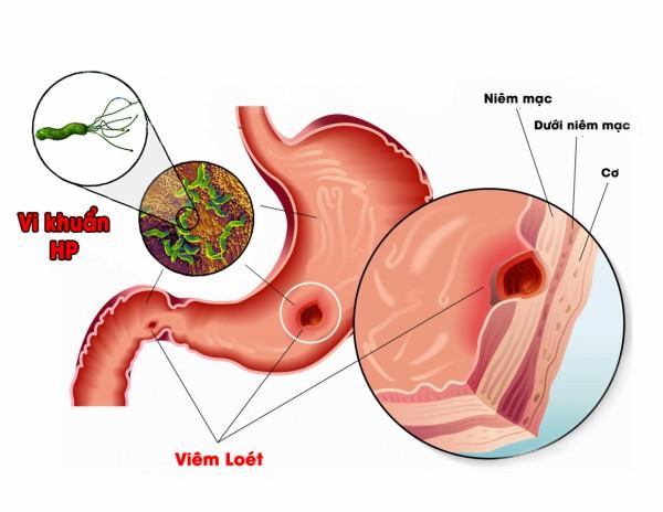 13 lý do bạn nên giảm lượng muối trong bữa ăn - 5