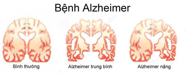 Nghiên cứu chấn động thế giới: Rối loạn giấc ngủ gây mất trí nhớ và Alzheimer - 2