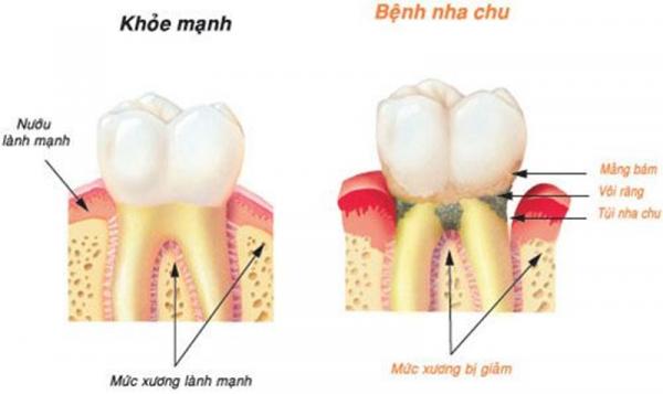 Cảnh giác với tình trạng chảy máu khi đánh răng và cách khắc phục - 1