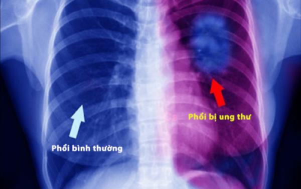 Đừng coi thường đau lưng. Đó có thể là dấu hiệu của 1 căn bệnh ung thư rất nguy hiểm - 1