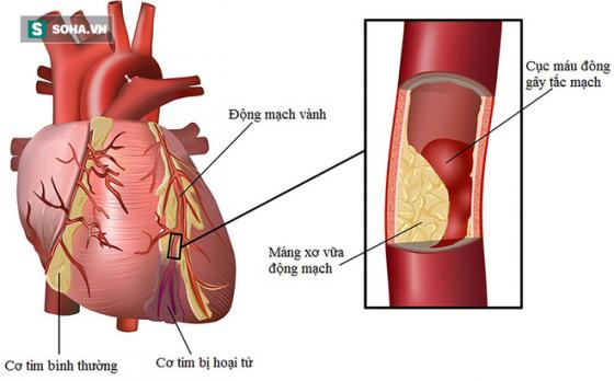 42 2 Nguoi Dang Duy Tri 3 Thoi Quen Nay Hay Canh Giac Vi Benh Mo Mau Cao Dang Cho Truoc Cua