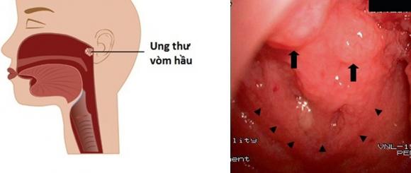 42 2 Nhung Dau Hieu De Nham Lan Cua Ung Thu Vom Hong