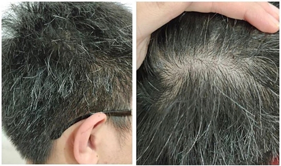 2 Co Phai Toc Bac Nhieu La Dau Hieu Cua Ung Thu