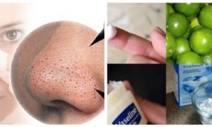 Chỉ với 1 thìa kem đánh răng, toàn bộ mụn đầu đen tự chui lên không cần nặn,...