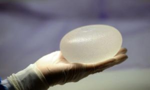 Gần 500 phụ nữ ở Mỹ bị ung thư do nâng ngực