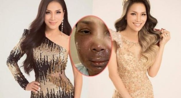 Hồng Ngọc lần đầu đăng ảnh trực diện bị bỏng sau sự cố nổ nồi xông hơi