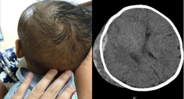 Ngã khi tập đi bằng xe tròn, bé 6 tháng bị tụ máu ngoài màng cứng