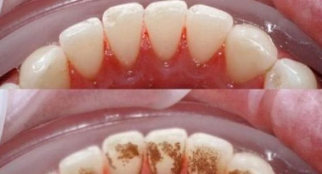 2 cách lấy cao răng đơn giản bạn cần ghi nhớ ngay hôm nay
