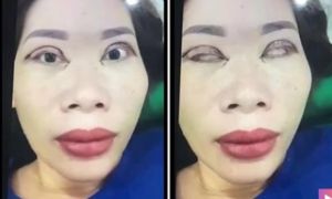 Cô gái trẻ bị mù sau khi cắt mí mắt tại spa