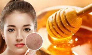 4 cách đánh bay mụn, giúp da trắng sáng mịn màng từ mật ong