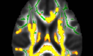 Mỡ bụng cảnh báo bệnh Alzheimer?